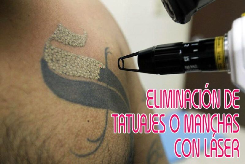 Eliminar-borrar-tatuaje-manchas-pigmentos-nevus-laser-madrid